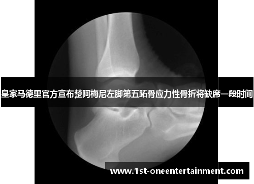 皇家马德里官方宣布楚阿梅尼左脚第五跖骨应力性骨折将缺席一段时间